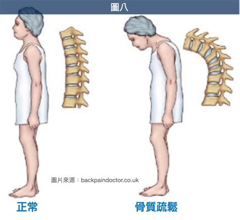 駝背造成的影響